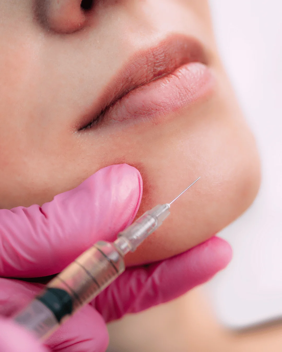 Tratamento Preenchedores (Ácido Hialurónico)